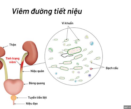 Nguyên nhân triệu chứng viêm tinh hoàn